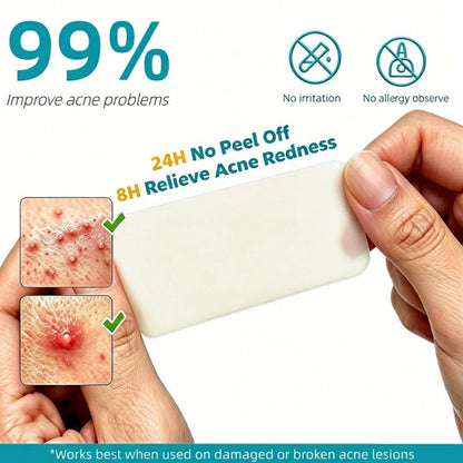 Medical-Grade Hydrocolloid Roll For Acne